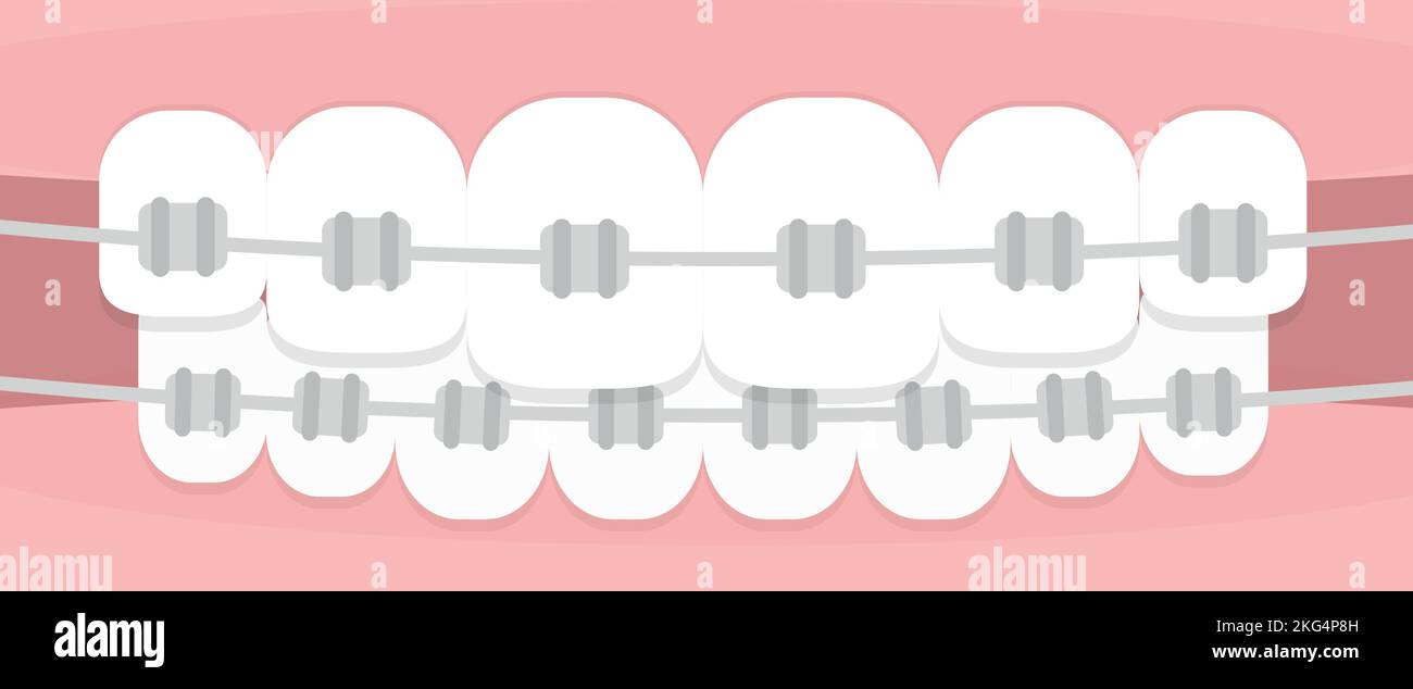 Teeth braces. Concept of orthodontics. Horizontal format. Vector