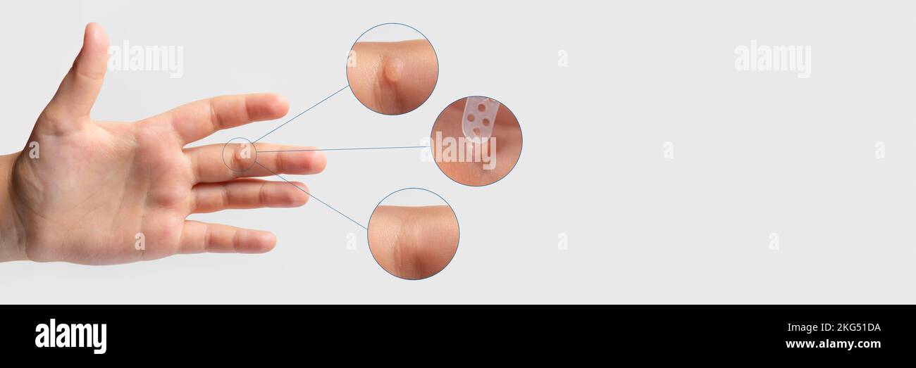 Wart on the finger. Closeup of wart treatment before and after. Apply