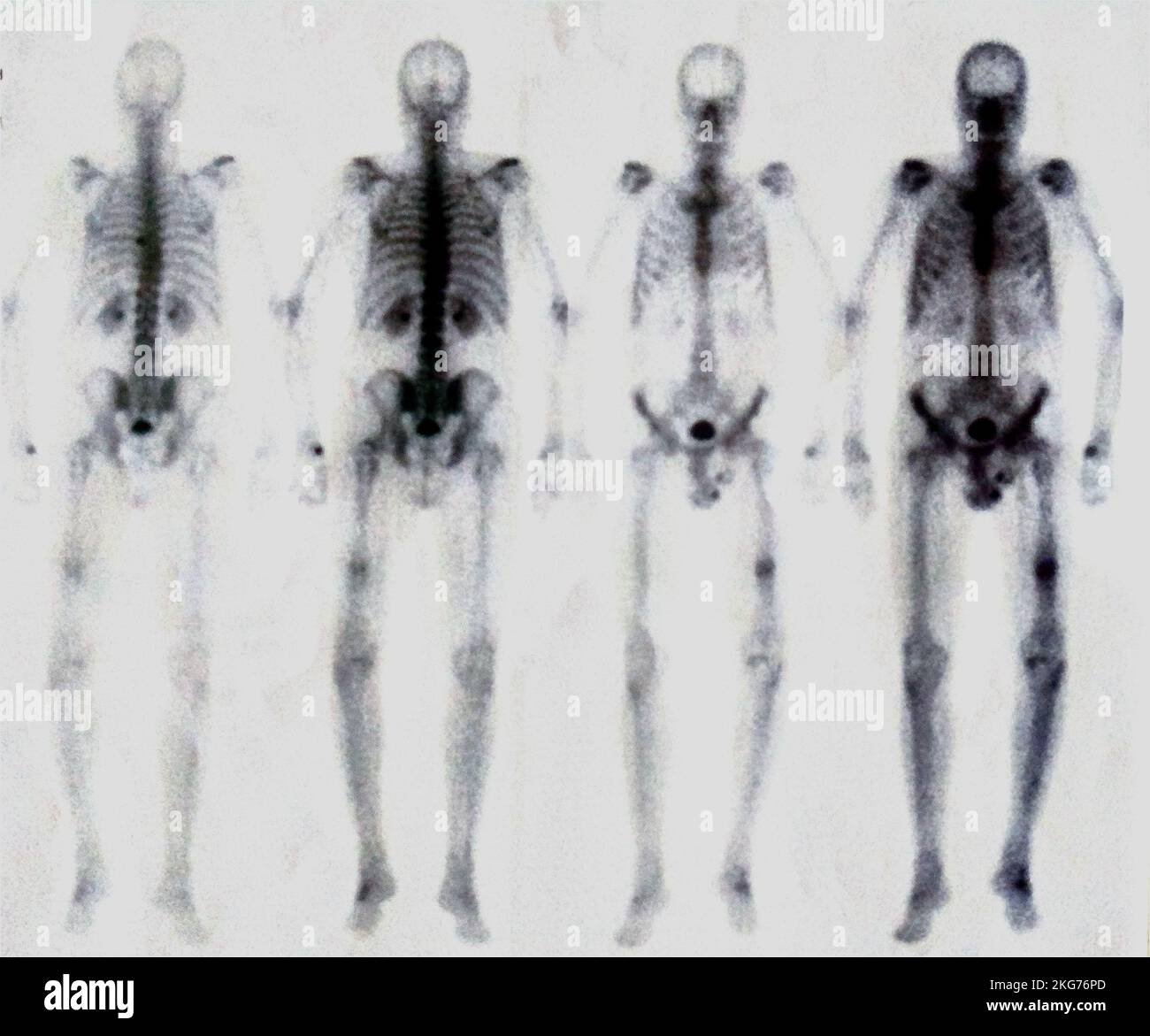 Scintigram of a man in the mid-sixties. Osteoarthritis diagnosis. Scintigraphy is a nuclear medicine examination method. Stock Photo