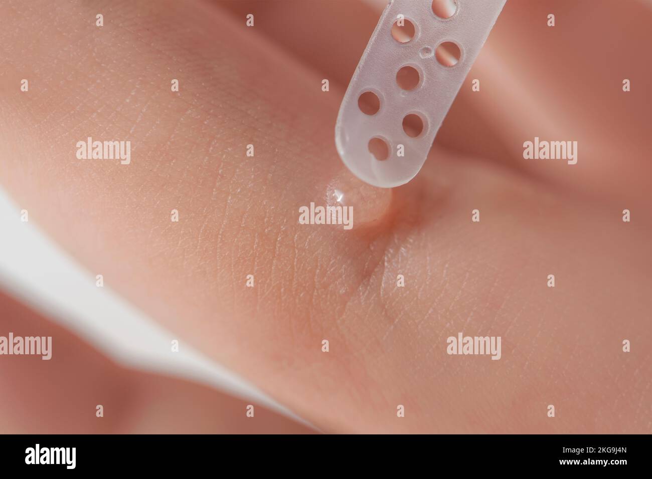 Apply the medicine to the wart with a special spatula or brush. Wart on the finger. Close-up plan of wart treatment. Human papillomavirus, HPV Stock Photo