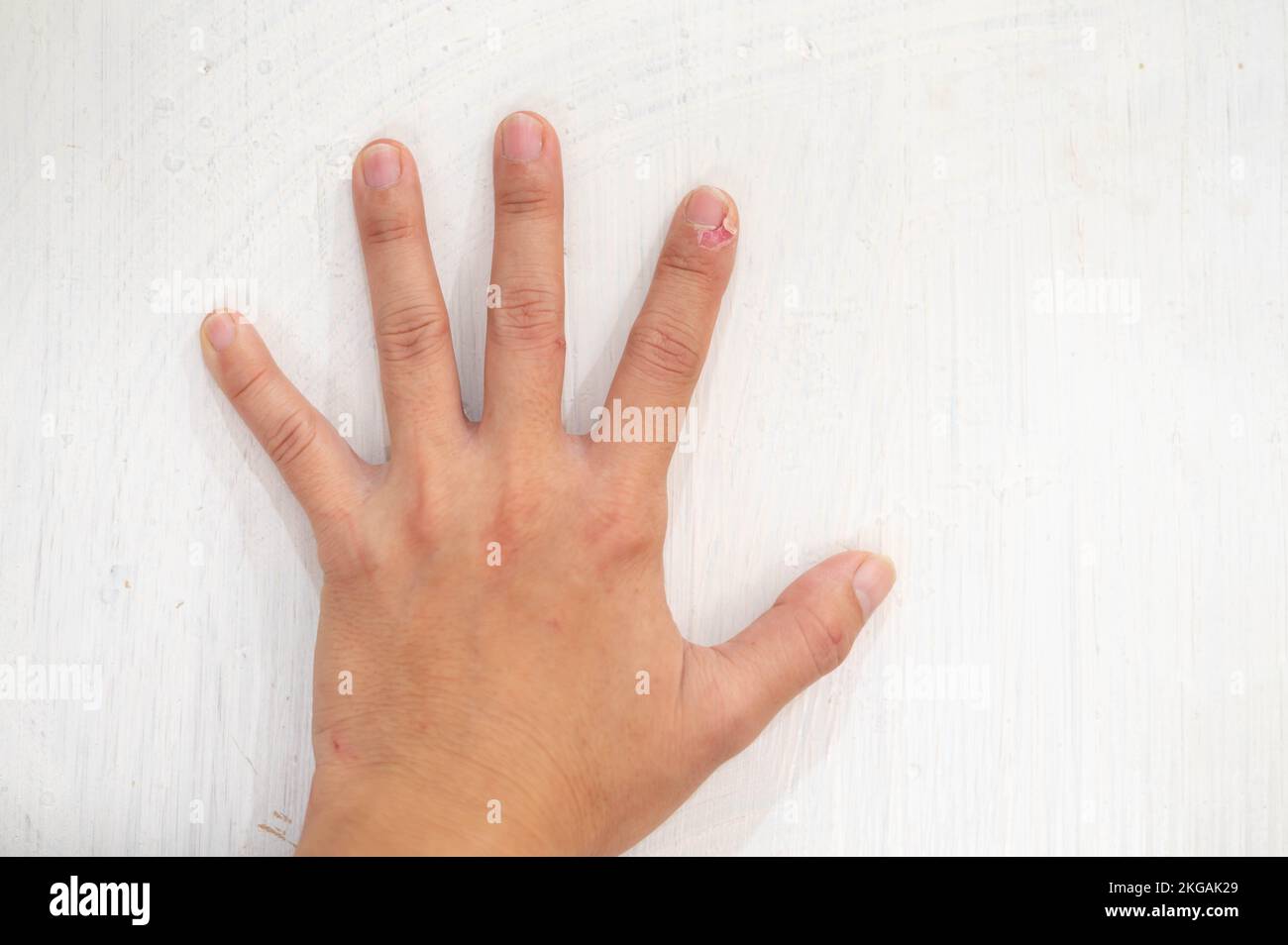 Closeup of fingers female hand with dry, cracked skin on cuticles, skin is torn and flaking off