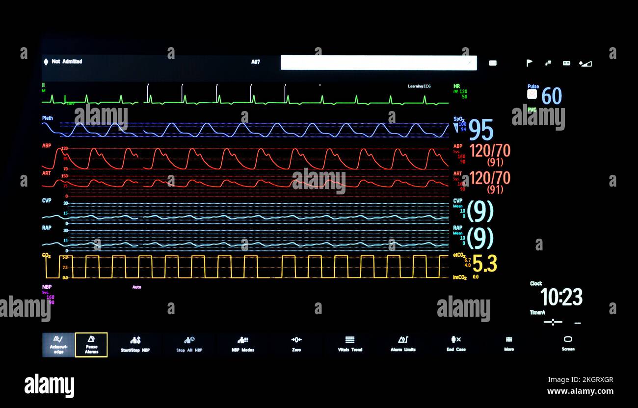 Screen of a bedside patient monitor in an English hospital. Stock Photo