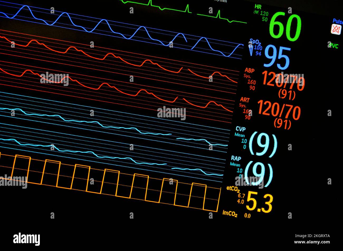 Screen of a bedside patient monitor in an English hospital. Stock Photo