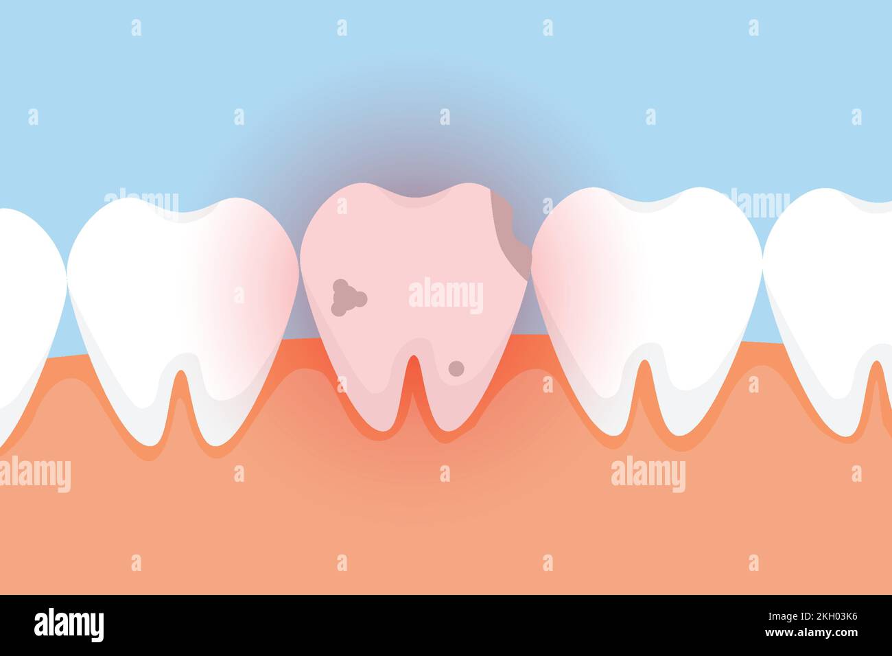 Bad tooth hurting with red danger glow effect vector. A dead tooth vector with a red glow effect. A dead tooth with cavities dental infographic elemen Stock Vector