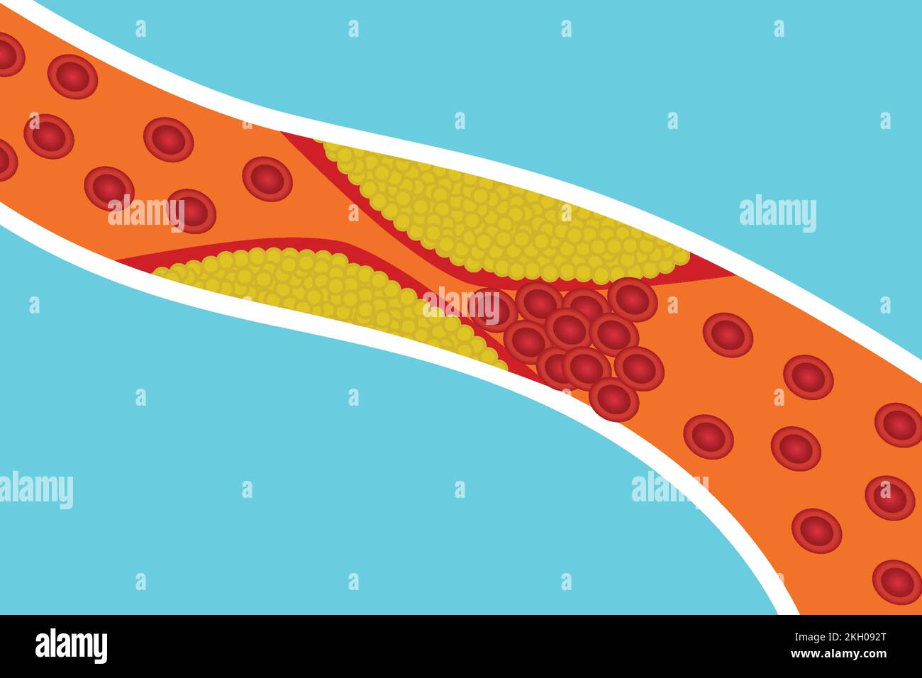 Blood circulation vessels are blocked by extra body fat. Red blood cells are blocked by yellow fat inside an artery. Human anatomy and blood clotting Stock Vector