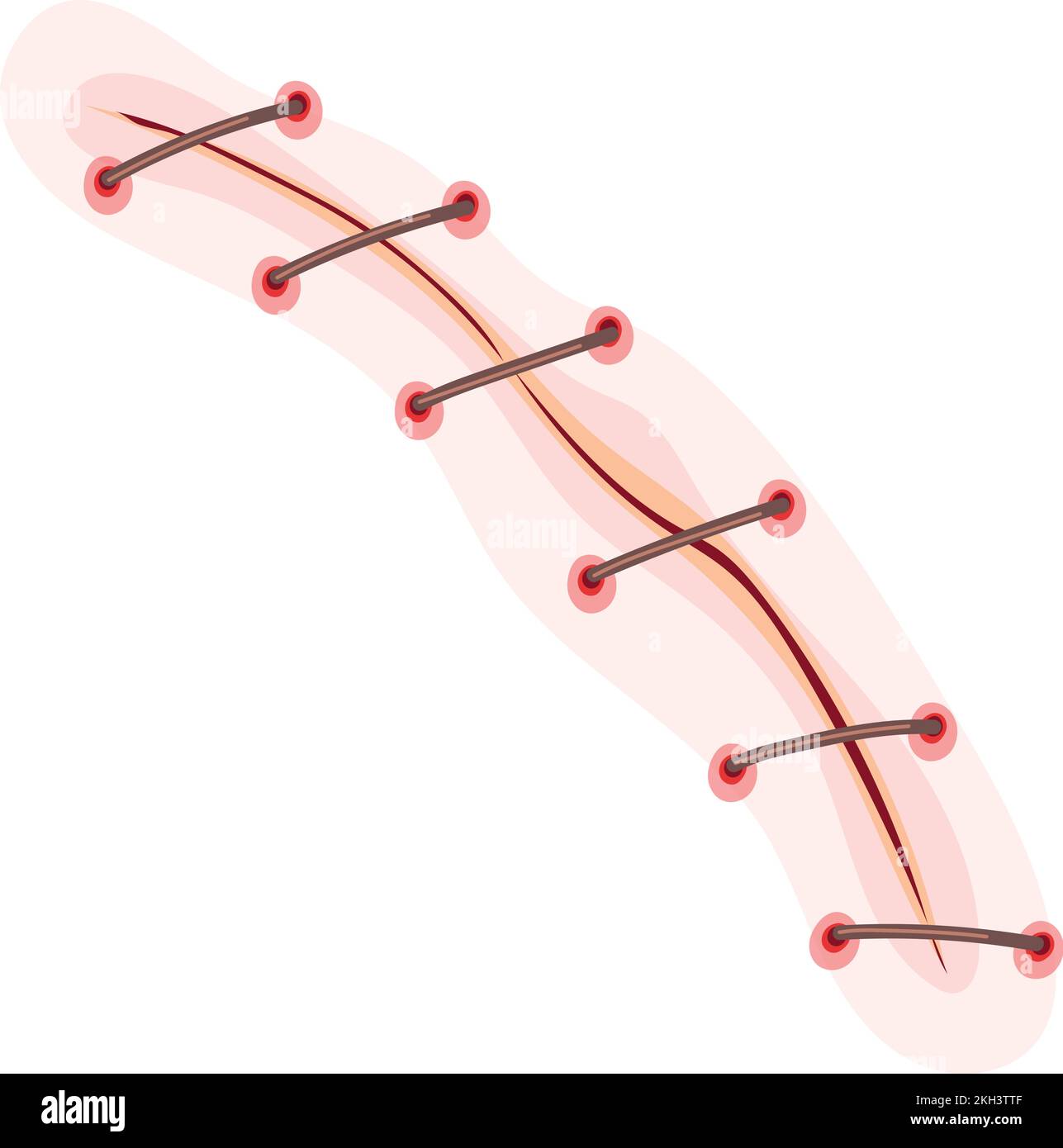 Surgery stitch. Body cut. Bloody wound mark isolated on white