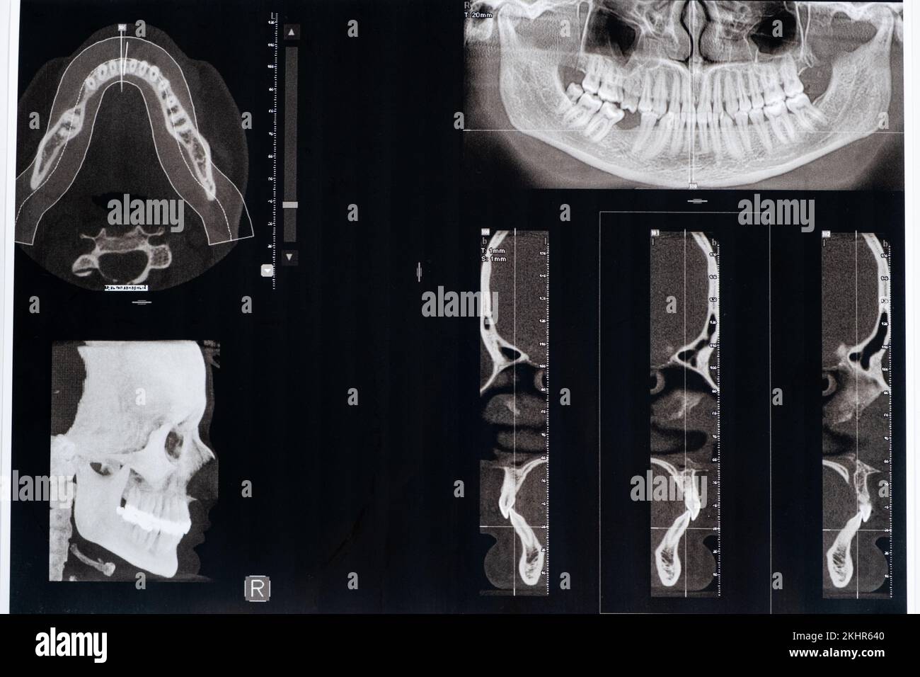 CT scan of a patient with malocclusion, missing chewing tooth and temporomandibular joint dysfunction. Stock Photo