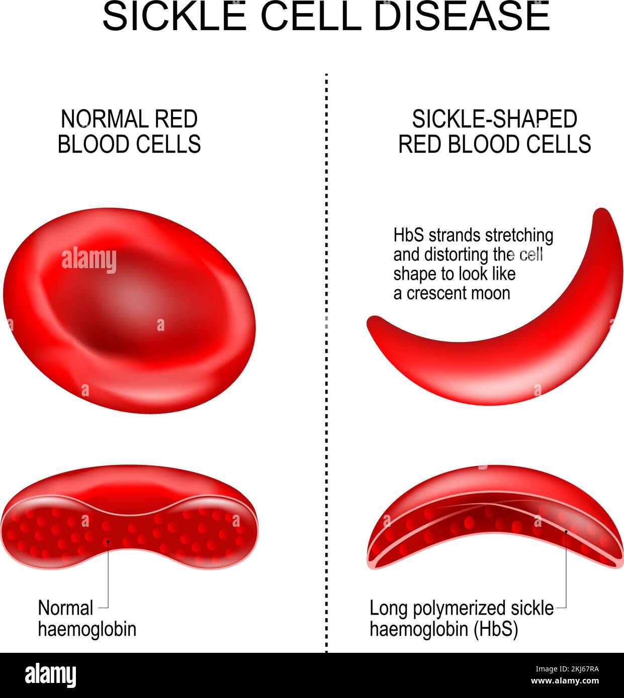 sickle cell disease. difference and comparison between Normal red blood cell and Sickle-shaped erythrocytes. HbS strands stretching and distorting the Stock Vector