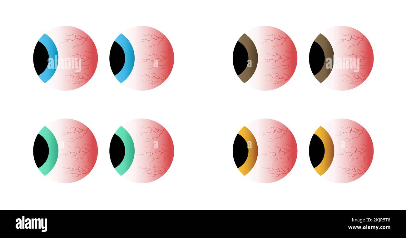 Red eyes different colors set. Sick stress, sleep insomnia disorder, capillaries and pupils