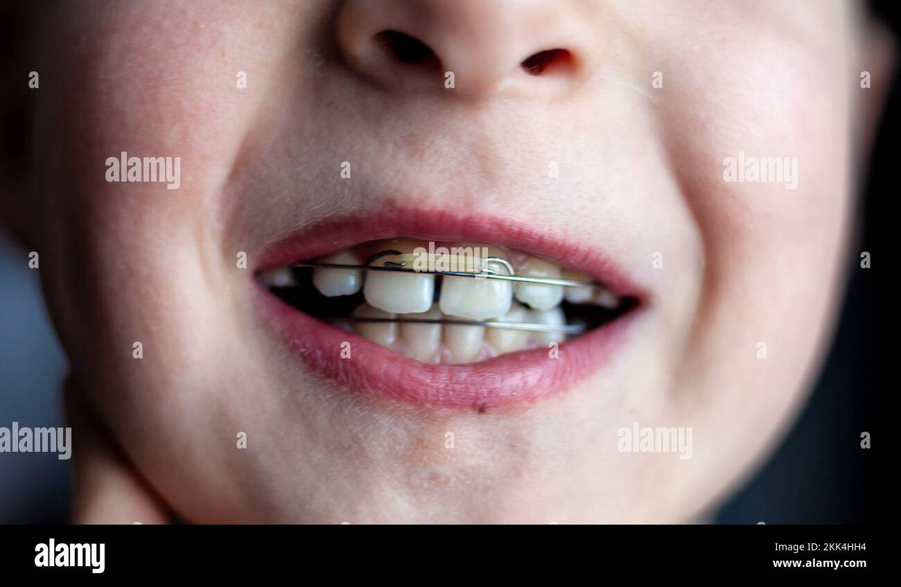 Orthodontist plates on children's teeth. Bite alignment. Orthodontic