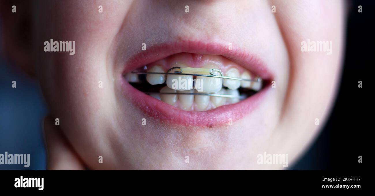 Orthodontist plates on children's teeth. Bite alignment. Orthodontic plate on the upper jaw. Children's tooth. Stock Photo