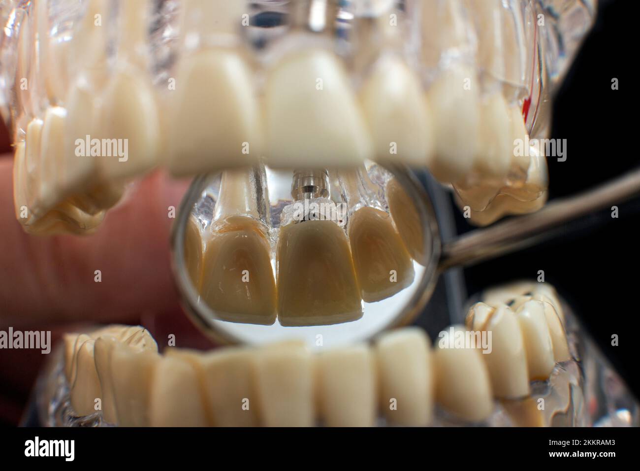 Dental jaw model over black background. Transparent invisible dental ...