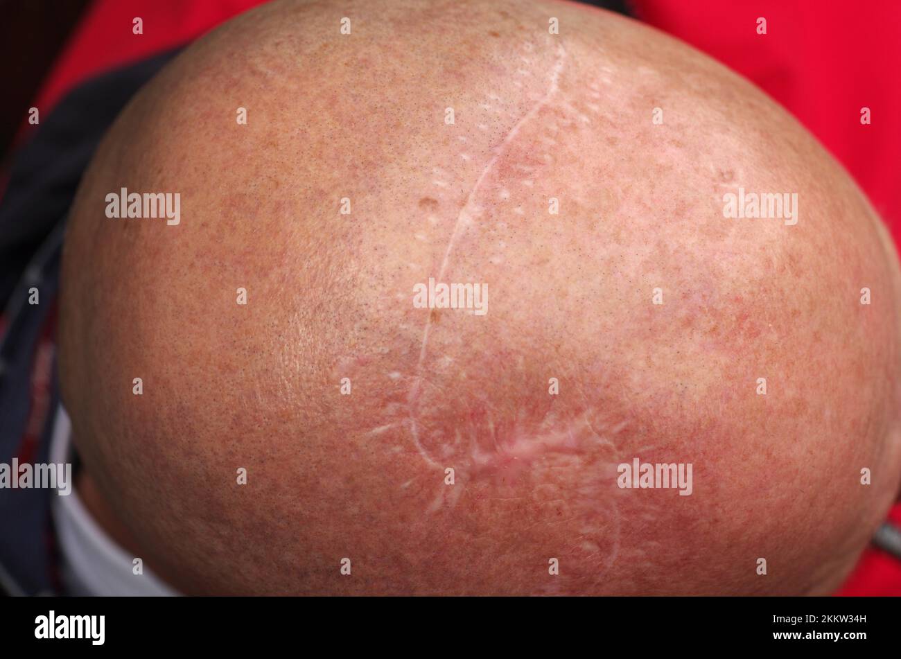 Close-up, head (caput), scar (cicatrix), there is a scar on the bald head, formed after an operation Stock Photo