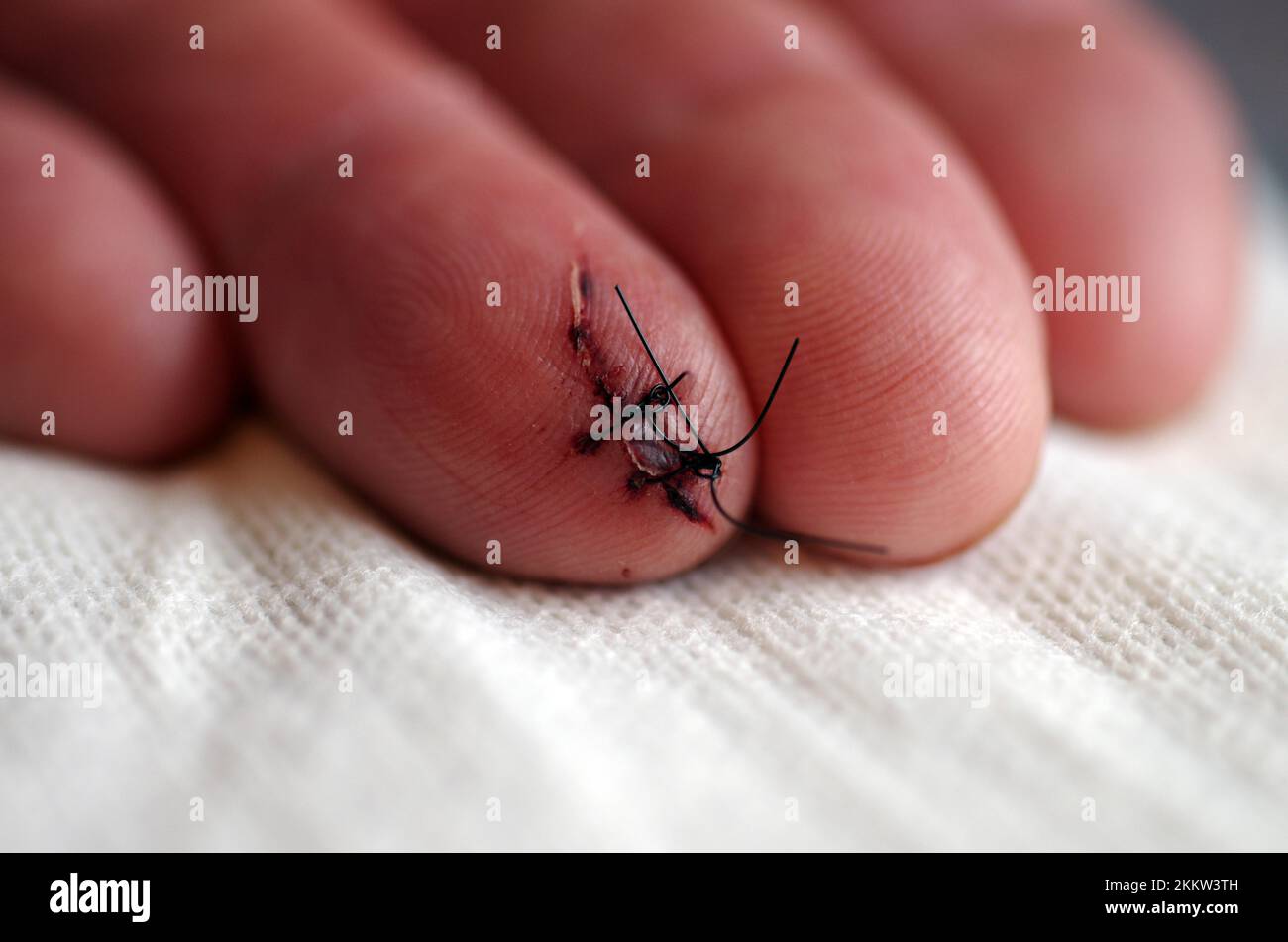 Closeup, finger (digitus manus), cut wound, freshly sutured cut wound