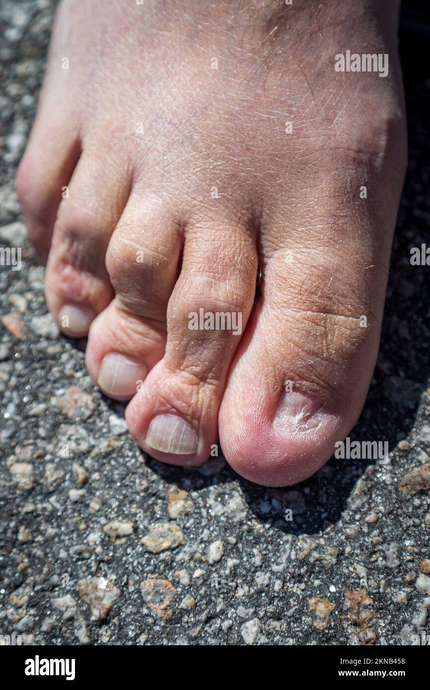 A close up of a  mans foot with the big toe nail missing Stock Photo