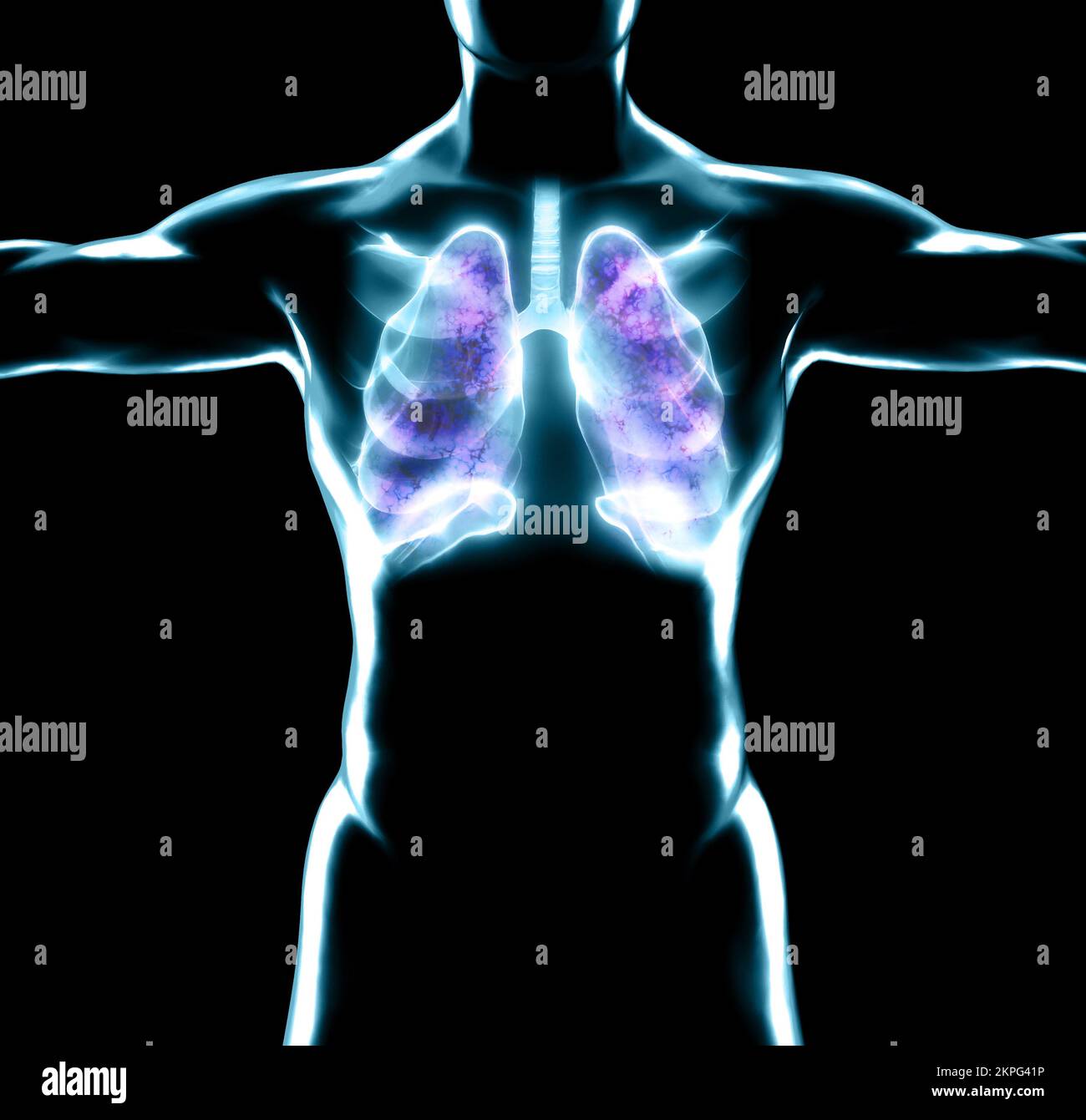 Human anatomy, problems with the respiratory system, severely damaged lungs. Bilateral pneumonia. Covid-19, coronavirus. Patient and smoke. Smoker Stock Photo