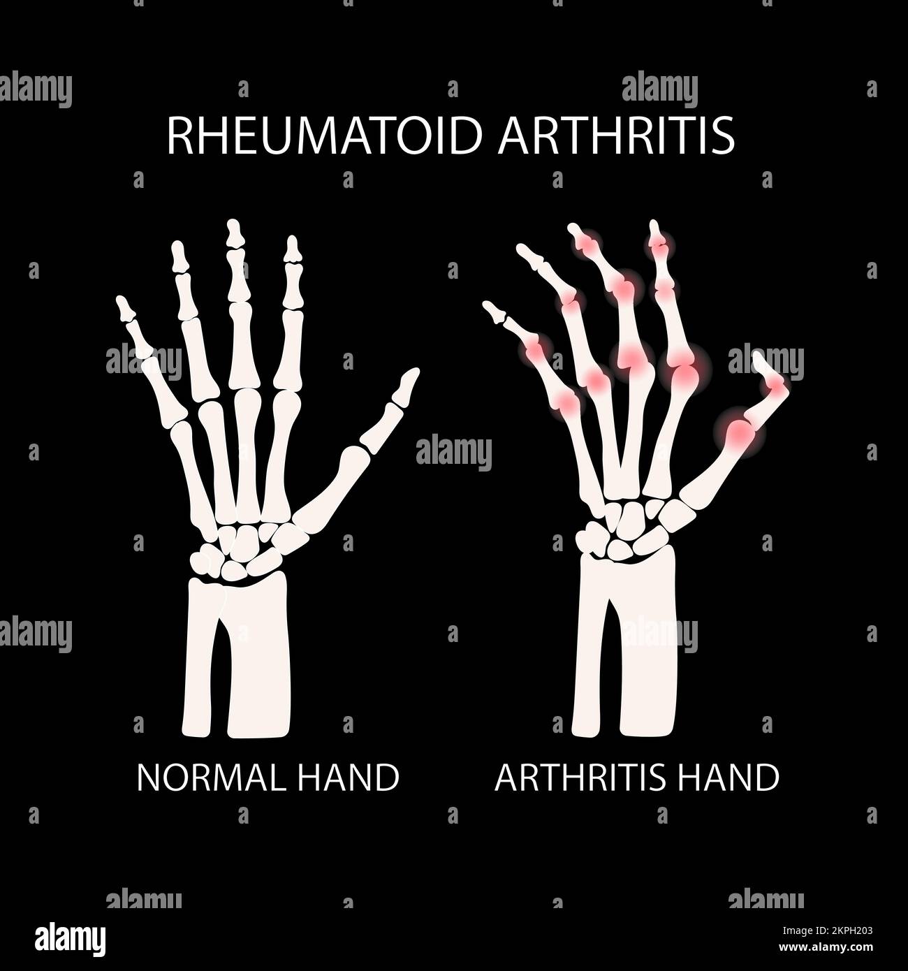 RHEUMATOID ARTHRITIS BLACK Human Chronic Disease Medical Education