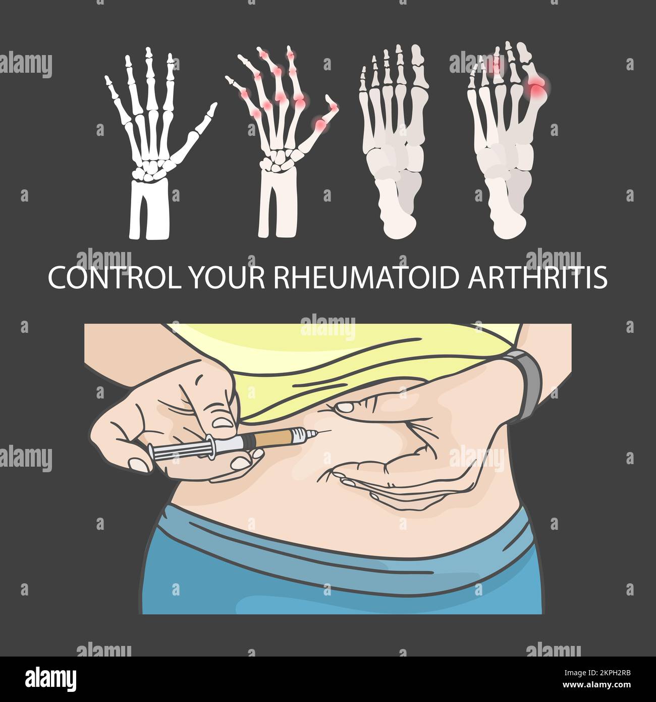 RHEUMATOID ARTHRITIS CONTROL Hypodermic Injection In Stomach Medical