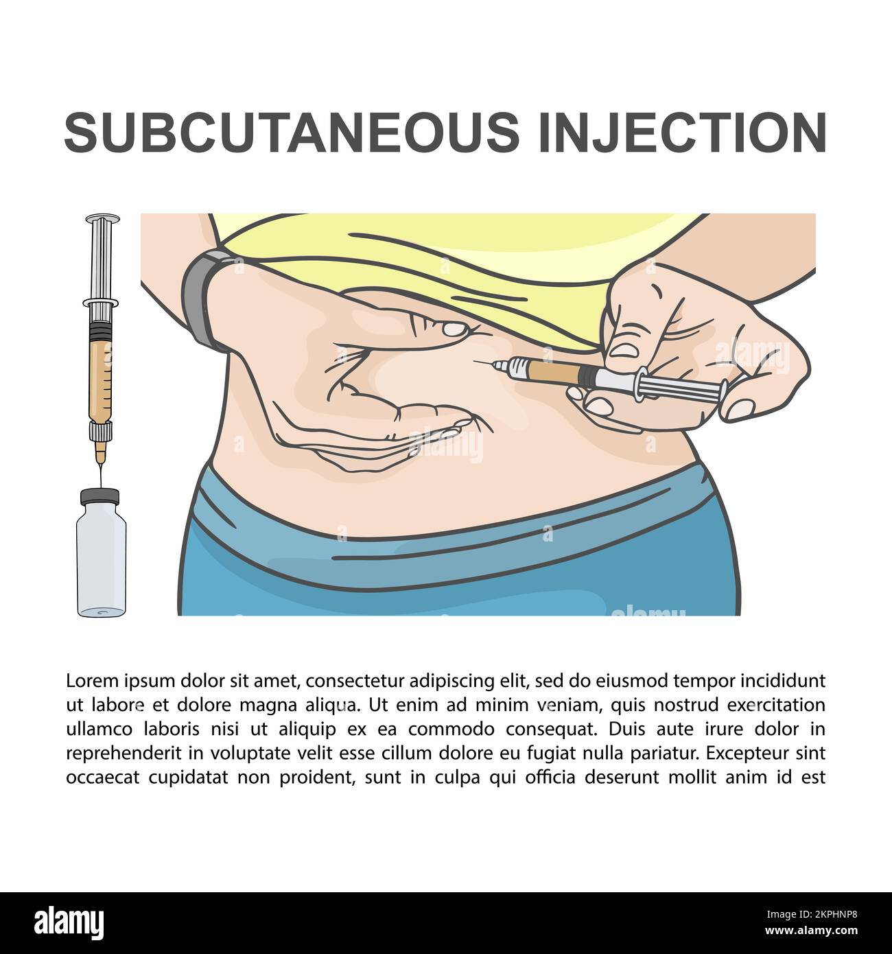 SUBCUTANEOUS INJECTION Into Abdomen Syringe In Hand Inserted Under Skin Educational Picture For Medical Facilities Students Clip Art Vector Illustrati Stock Vector