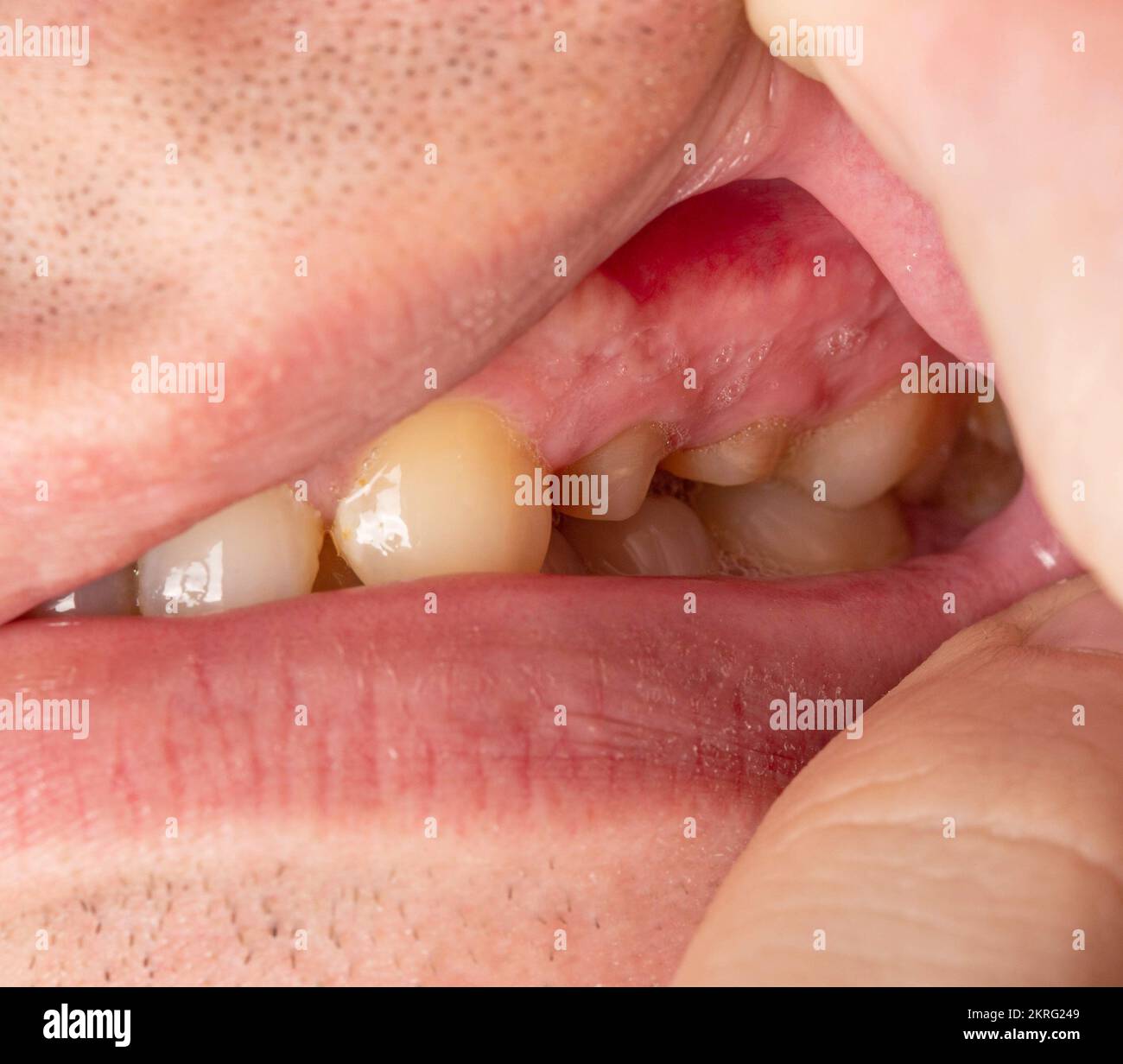 Dissection of decayed teeth for the installation of a dental crown in