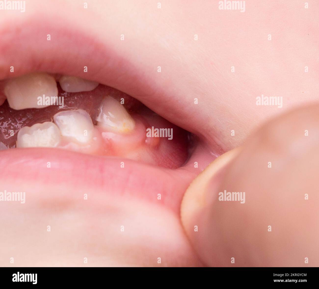 Red swelling on the gums of a child in the oral cavity. Fistulabump