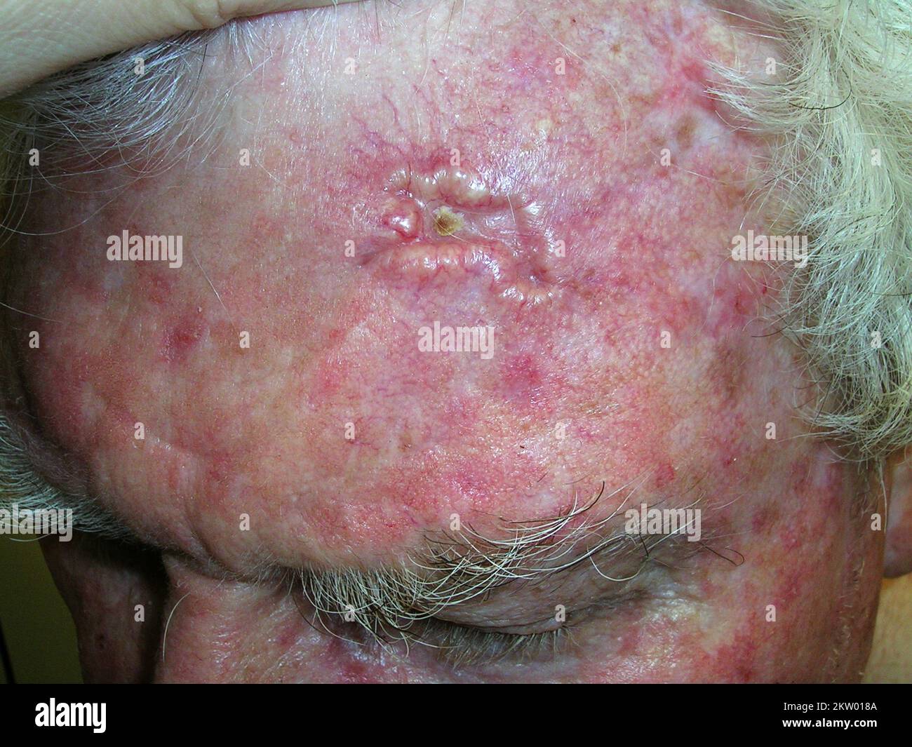 Basal cell carcinoma Stock Photo - Alamy