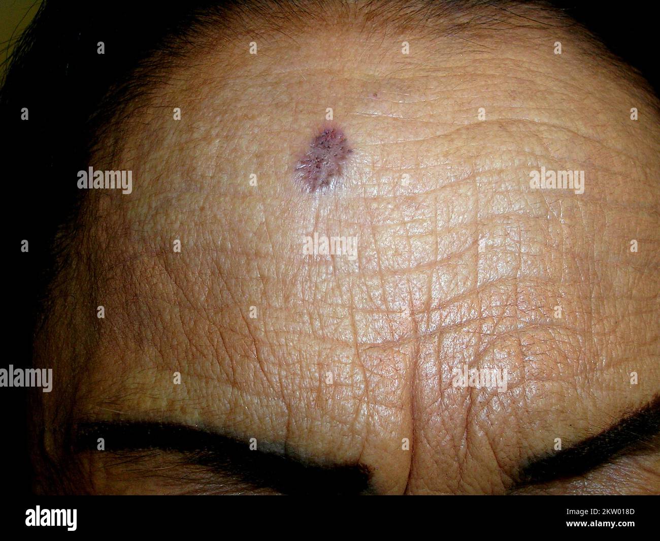 Basal cell carcinoma Stock Photo - Alamy
