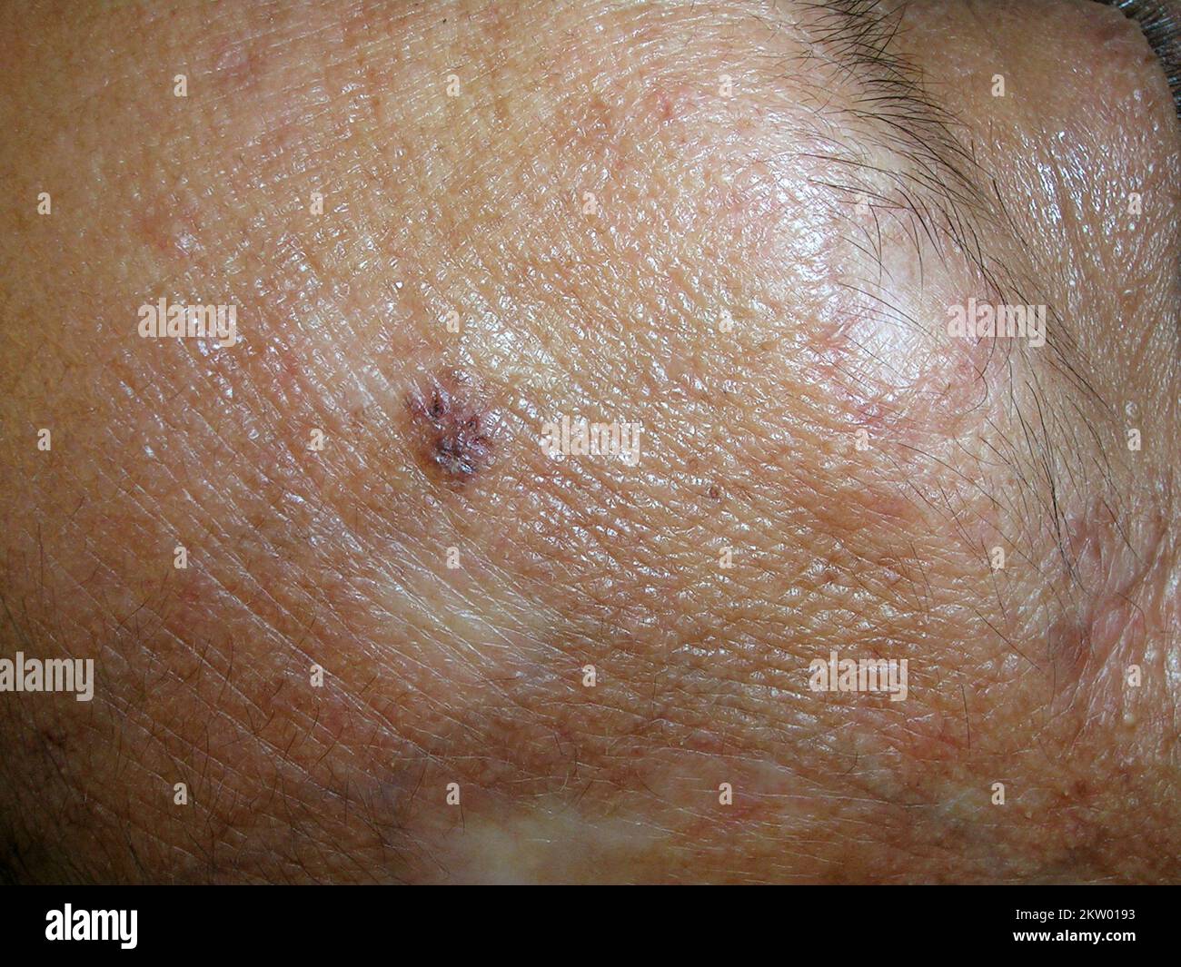 Basal cell carcinoma Stock Photo - Alamy