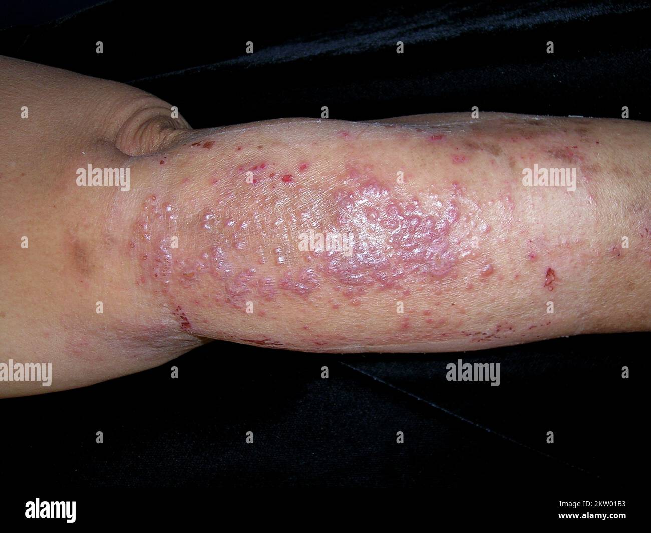 Allergic contact dermatitis Stock Photo Alamy
