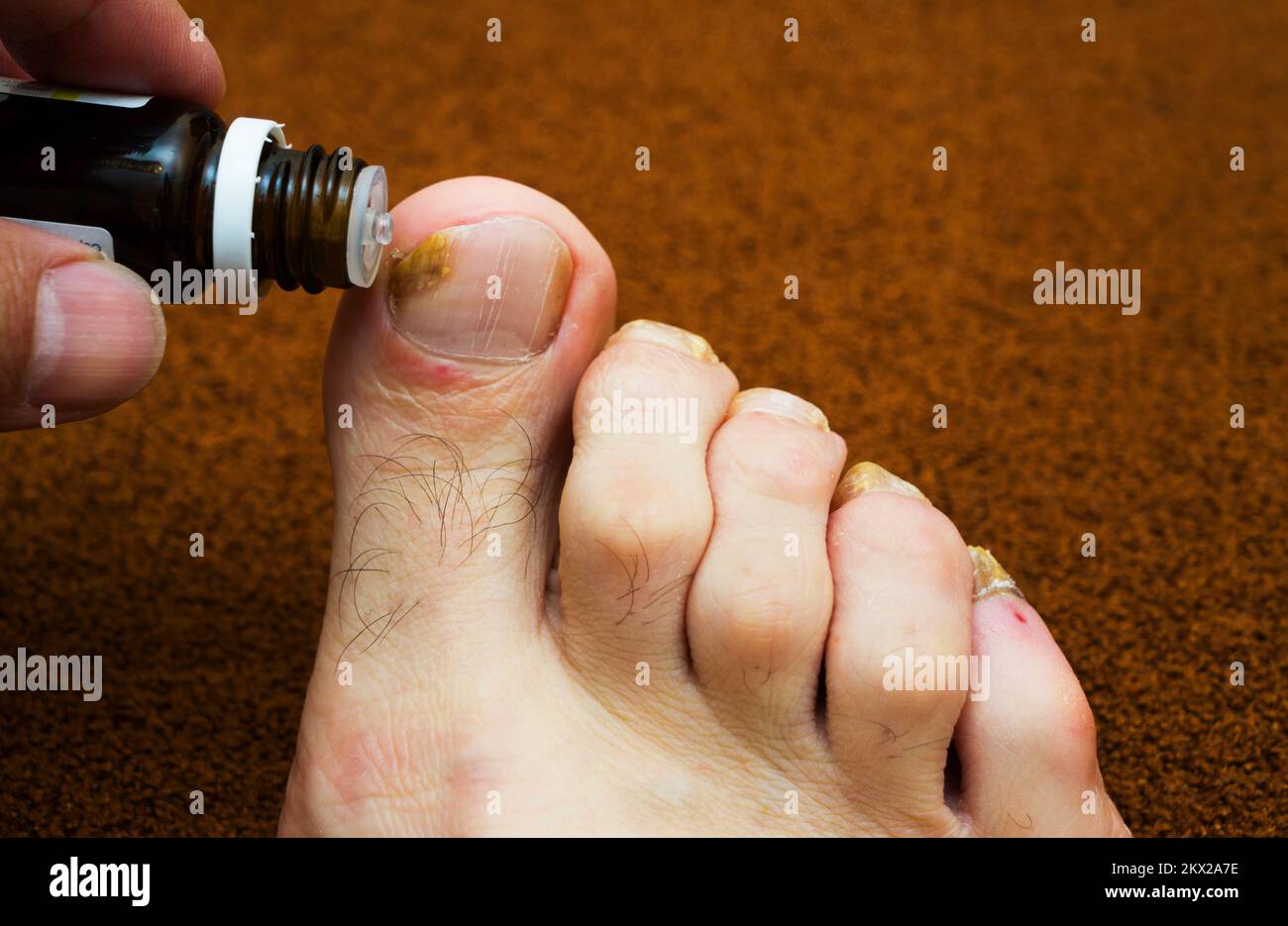 Toe and nail fungus. Dermatologist. The doctor treats the patient's