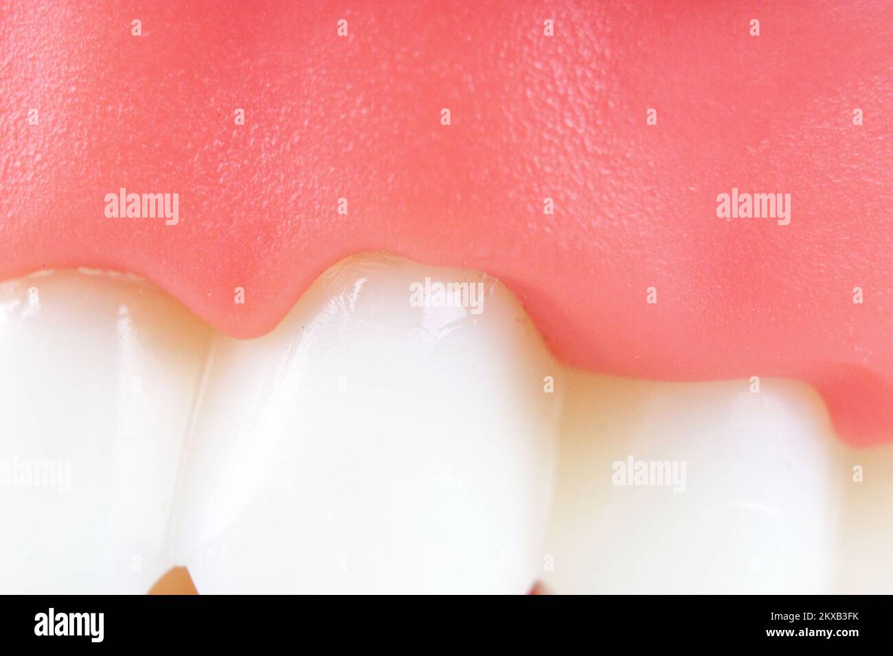 Dentures Dental Teeth Model. Complete denture or full denture on blue background. Close-Up Of Dentures Against Blue Background. Denture picture with f Stock Photo