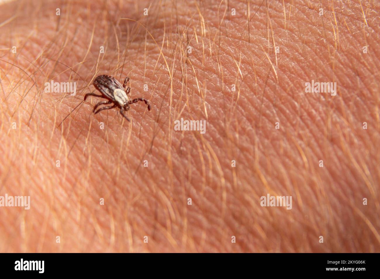 Removing A Tick From A Human