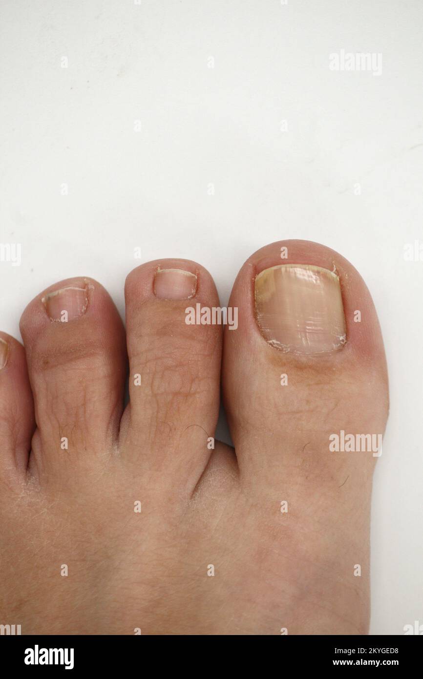 Big toe nail of a person suffering from onychomycosis, a fungal
