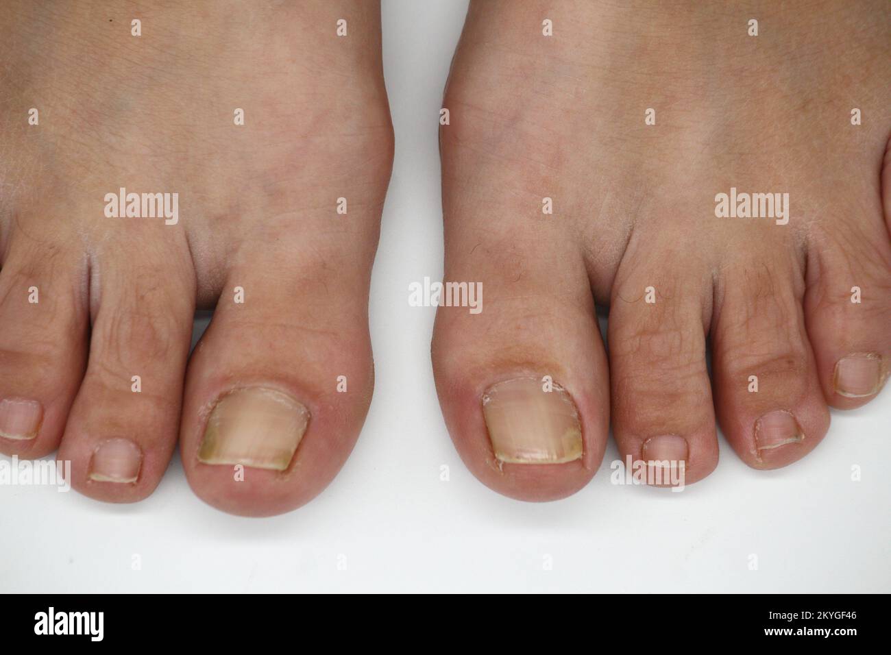 Big toe nail of a person suffering from onychomycosis, a fungal infection that causes yellowing of the nail Stock Photo