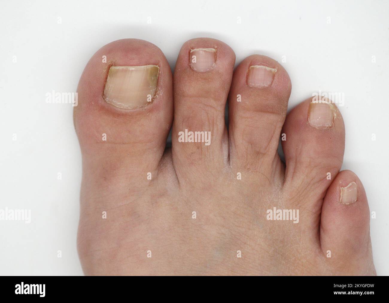 Big toe nail of a person suffering from onychomycosis, a fungal infection that causes yellowing of the nail Stock Photo