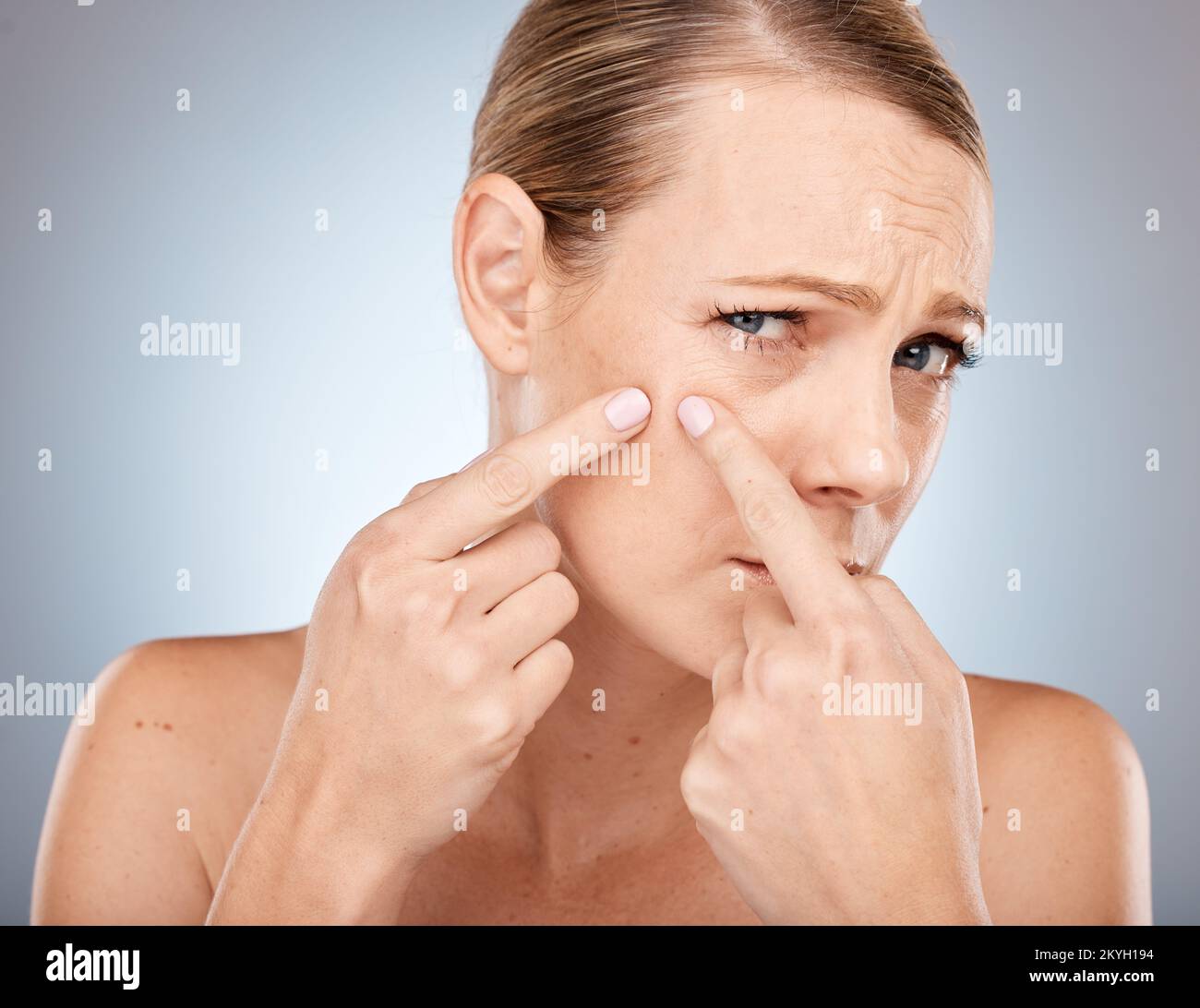 Face, skincare and woman squeeze acne, pimple or blackhead in studio on a gray background. Wellness, dermatology and cosmetology portrait of sad Stock Photo