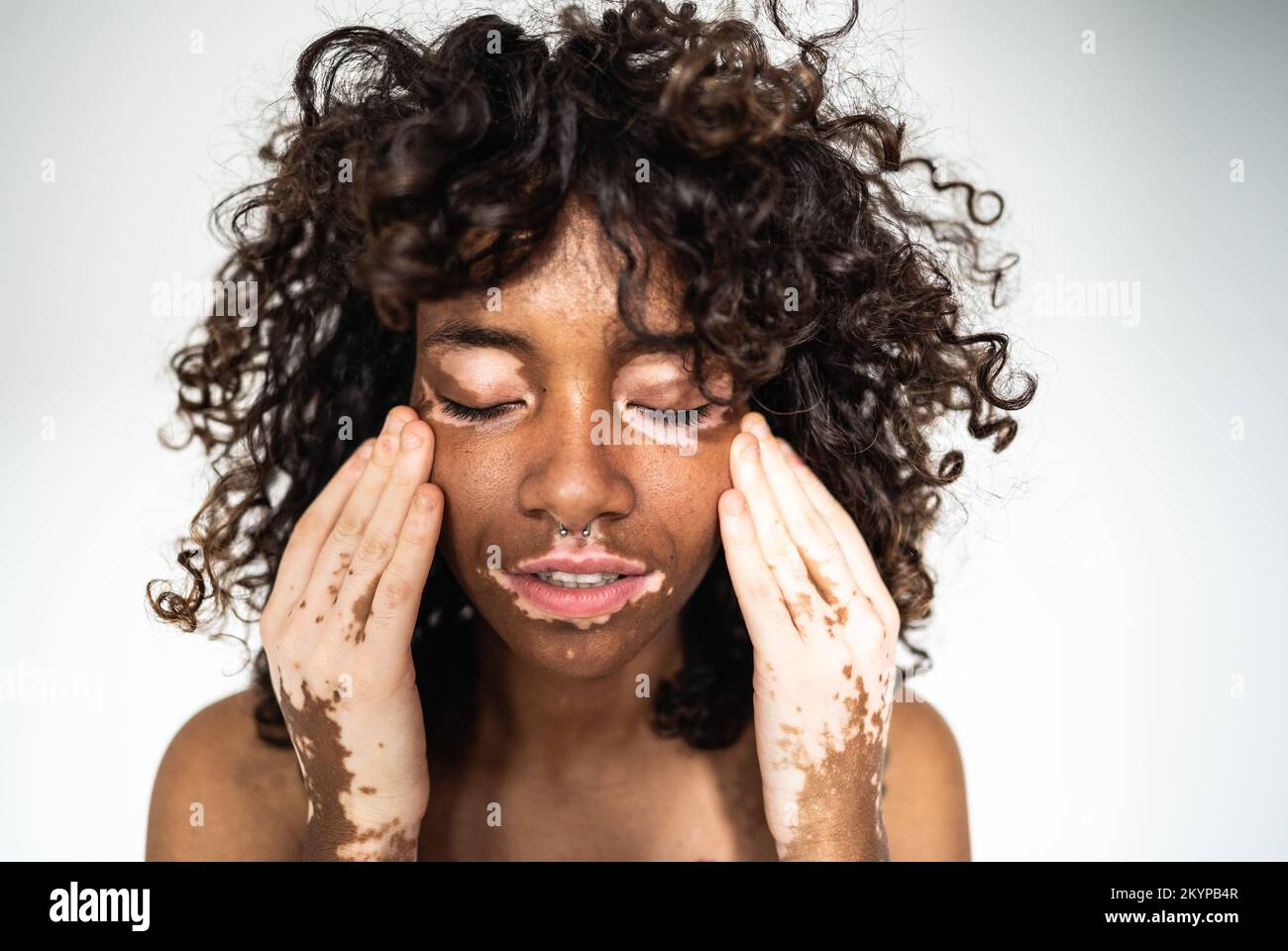 Portrait of young woman with vitiligo condition caress his skin. Close up of attractive young woman with skin disorder. Stock Photo