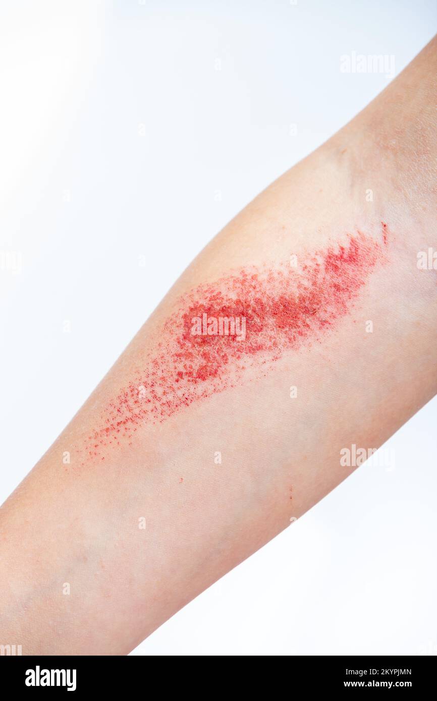 Children's hand burn. Children's hand with a burnt wound on a white background.Close up Stock