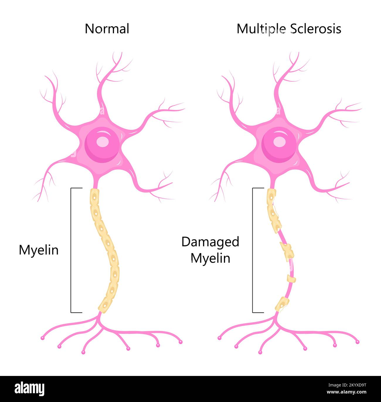 Neuron concept vector. Dendrite, axon, soma of neuron. Multiple sclerosis, nerve anatomy illustration. Stock Vector