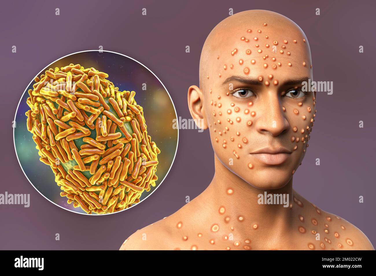 Patient with monkeypox infection, computer illustration. Monkeypox is a zoonotic virus from the Poxviridae family that causes monkeypox, a pox-like di Stock Photo