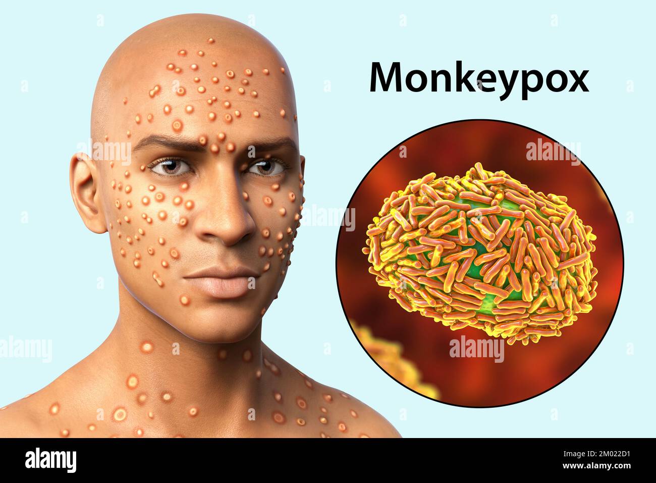 Patient with monkeypox infection, computer illustration. Monkeypox is a zoonotic virus from the Poxviridae family that causes monkeypox, a pox-like di Stock Photo