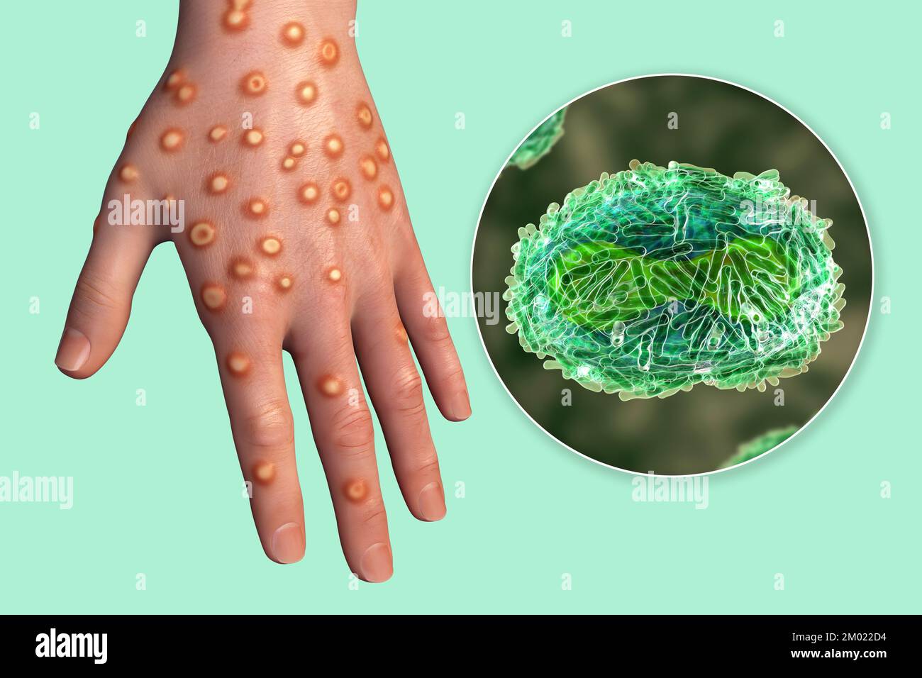 Hand of a patient with monkeypox infection and close-up view of monkeypox virus particles, computer illustration. Monkeypox is a zoonotic virus from t Stock Photo