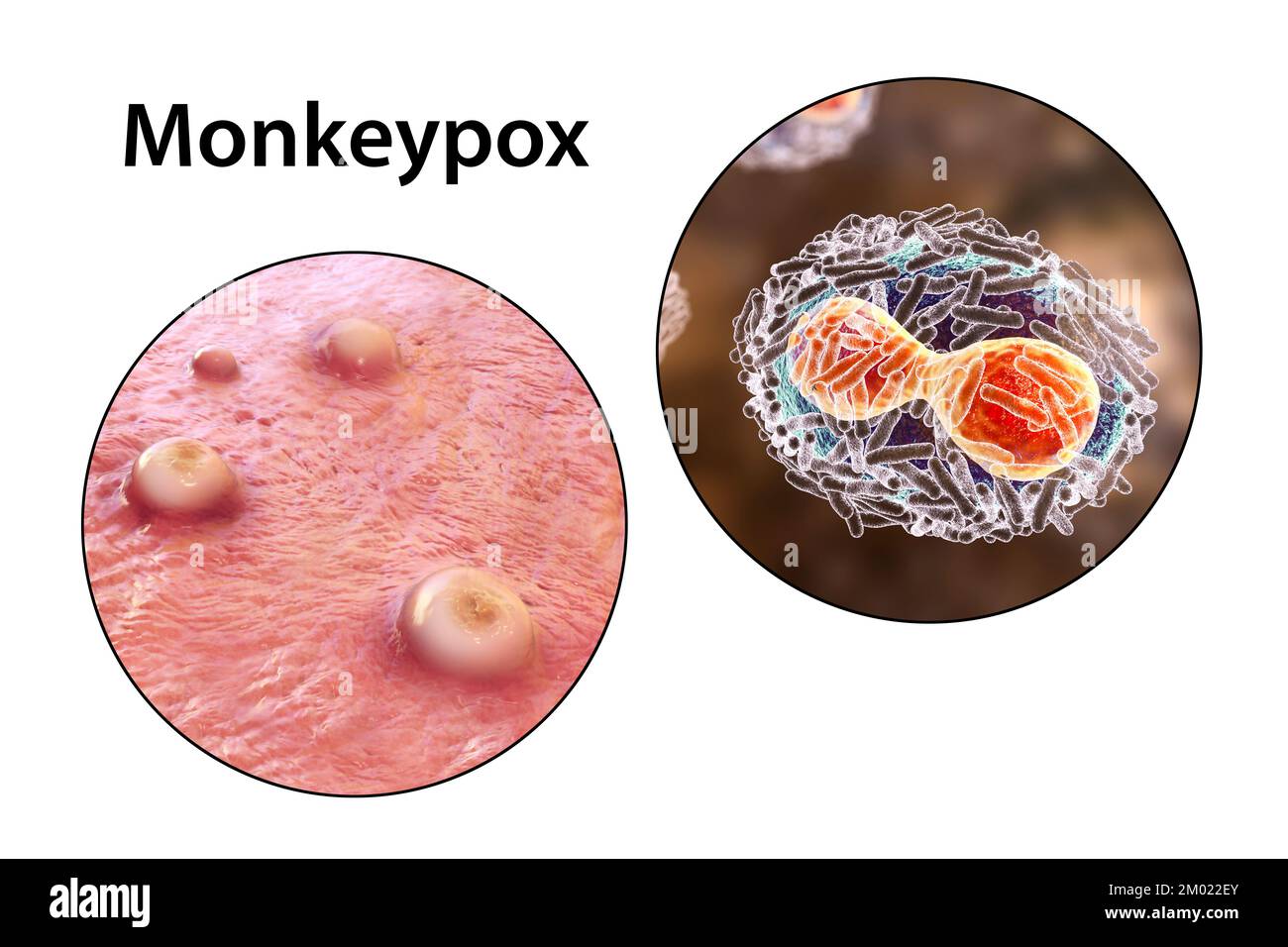 Skin lesions in monkeypox infection and close-up view of monkeypox virus particles, computer illustration. Monkeypox virus is found near rainforests i Stock Photo
