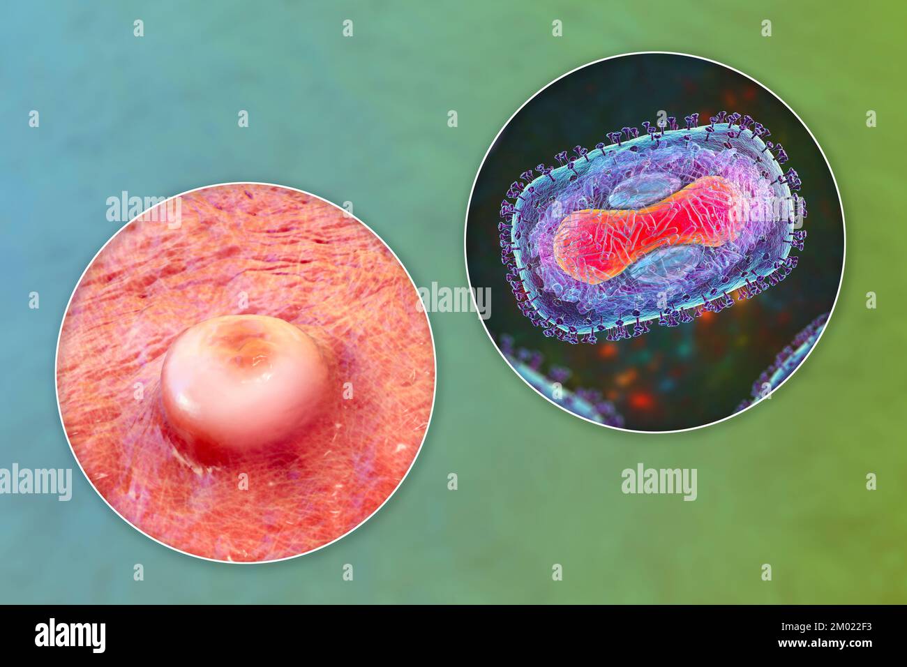 Mpox hires stock photography and images Alamy