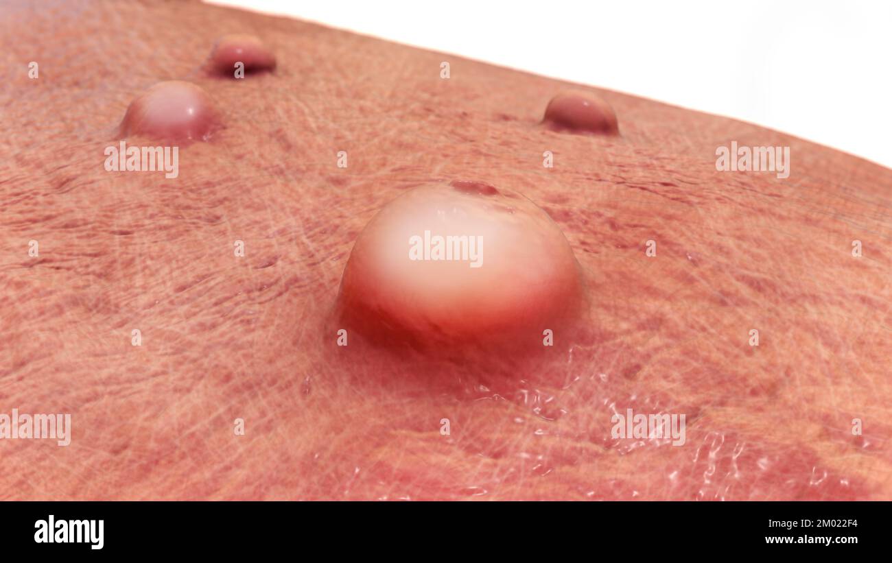 Skin lesions in monkeypox infection, computer illustration. Monkeypox virus is found near rainforests in Central and West Africa, causes disease in hu Stock Photo