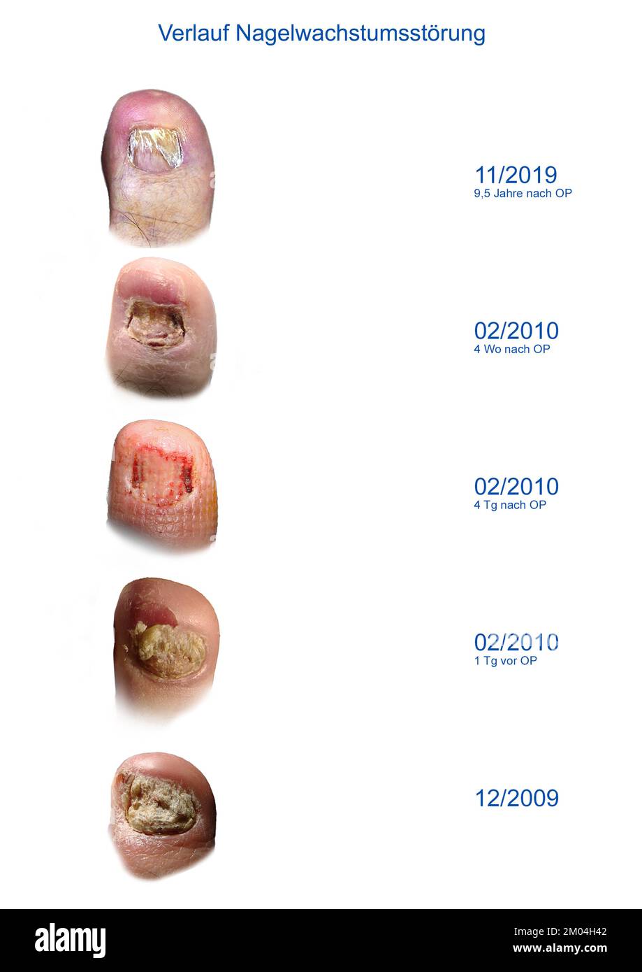 Verlauf Nagelwachstumsstörung vor und nach operativer Entfernung der Nagelplatte. Heilungsverlauf Stock Photo