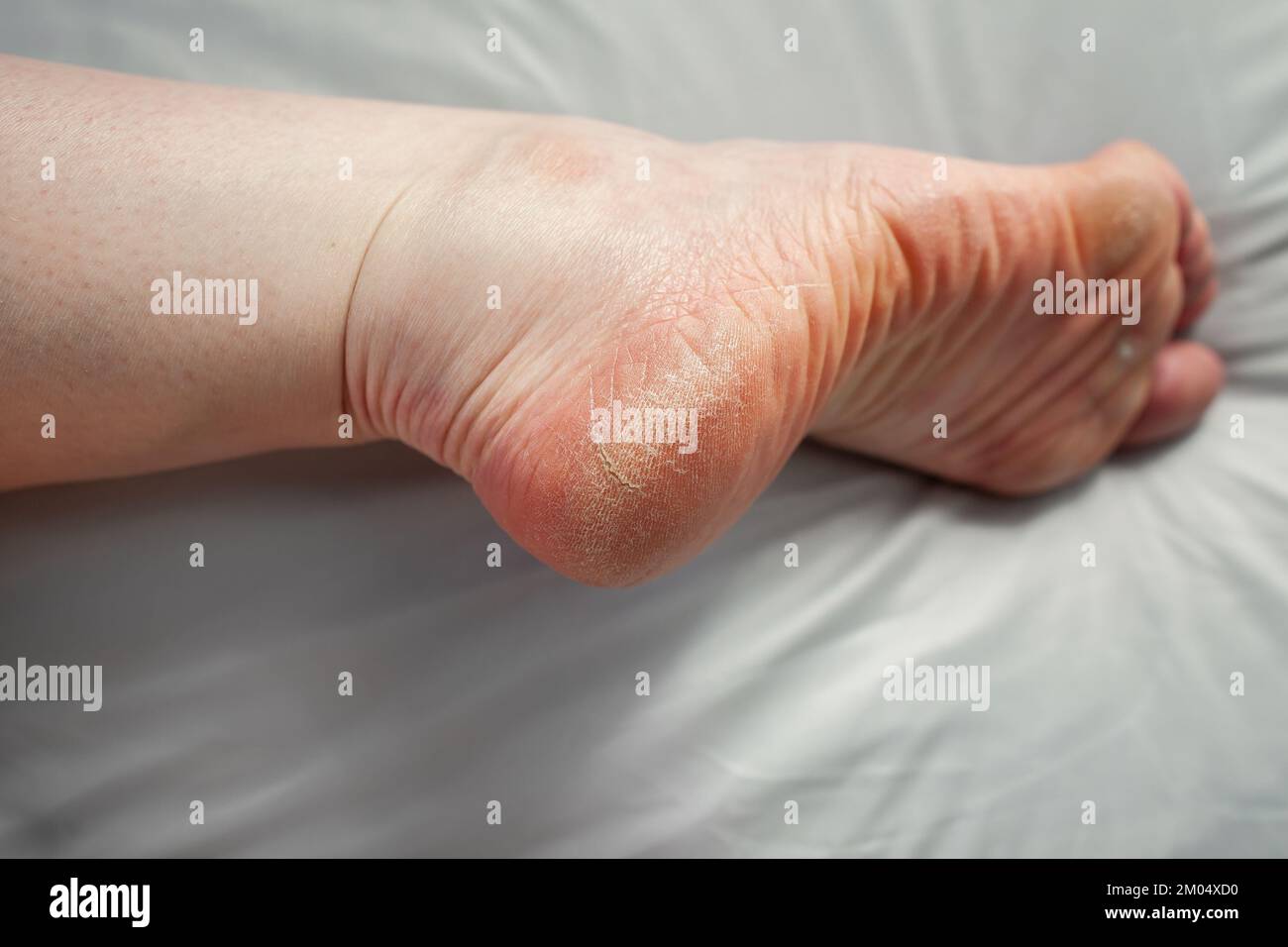 Foot of person with Raynaud's and EhlersDanlos syndrome (EDS) with