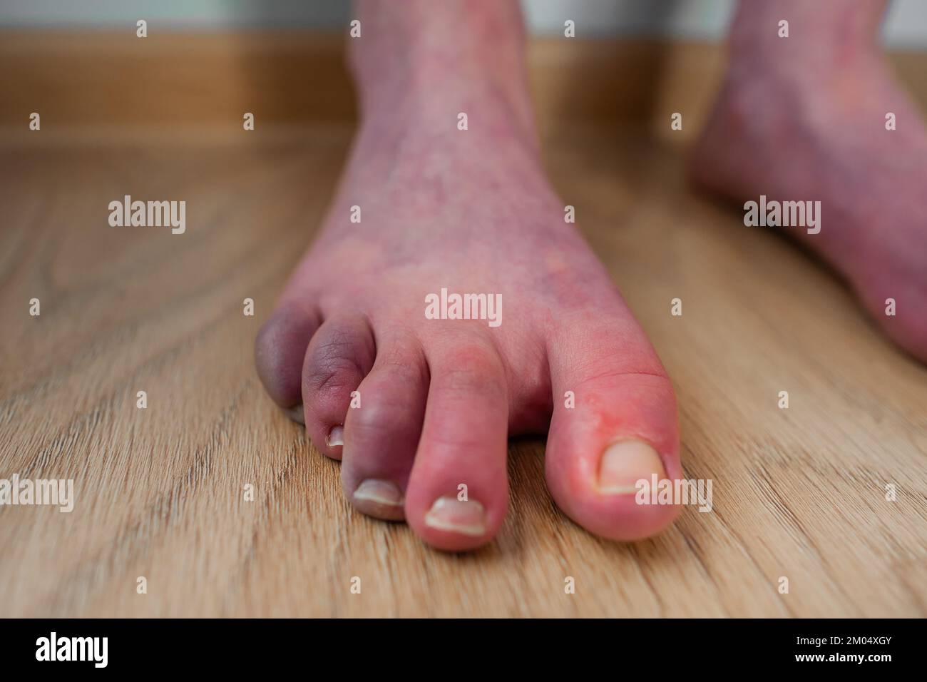 Closeup of feet of person with orthostatic intolerance POTS with dark