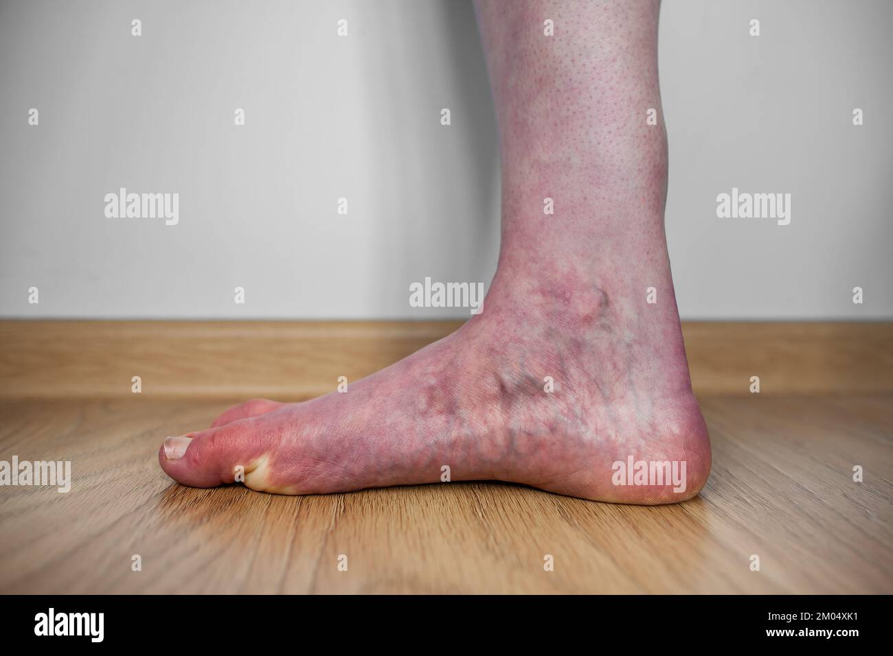 Leg of person with orthostatic intolerance syndrome with purple discoloration upon standing, Dysautonomia blood pooling in legs Livedo reticularis Stock Photo