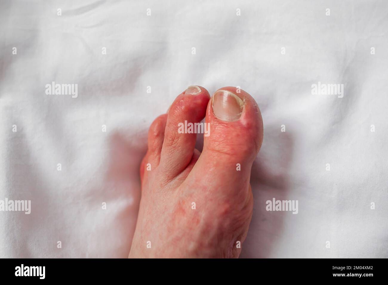 Foot of person with Raynaud's phenomenon with chilblains blisters and red swollen toes Pernio